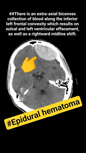 #Left parietal scalp hematoma with skin staples are present in CT scan #shortvideo