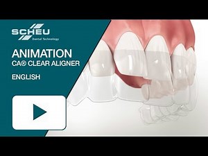CA® CLEAR ALIGNER Animation (english)