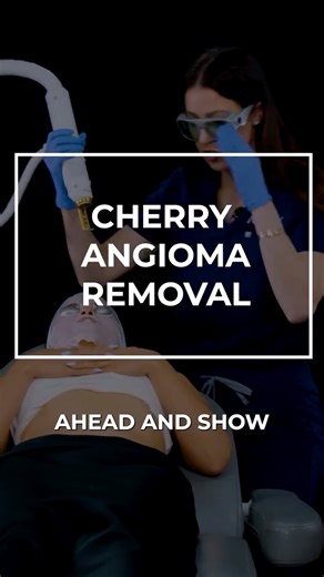 Empire Medical Training on Instagram: "✨ Cherry Angioma Removal with Aerolase® ✨ Fast. Precise. Minimal downtime. 🔥 Cherry angiomas are common benign vascular lesions—and with Aerolase® laser technology, providers can safely and effectively treat them with high patient satisfaction. ✅ Typically only 1 session needed ✅ Larger angiomas may require a 2nd session ✅ Quick treatment time + minimal disruption to the skin ✅ Great add-on service for aesthetic practices 💉 Want to offer this in your clin