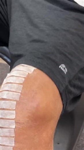 188K views · 624 reactions |  2 Weeks After Knee Replacement Surgery...