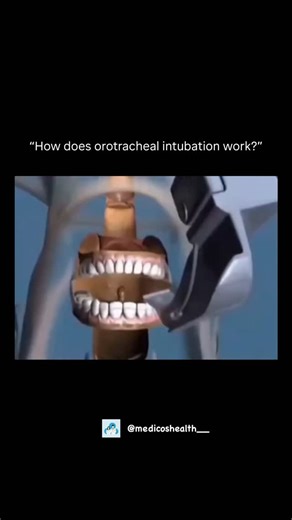 Medical & Health ⚕️ on Instagram: "How does orotracheal intubation work? 🫁 Orotracheal intubation is the placement of a tube through the mouth into the trachea to ensure proper oxygen delivery to the lungs. When is it necessary? 🚑 General anesthesia surgeries, respiratory failure, decreased level of consciousness, and emergencies. Step-by-step (summary): 😮‍💨 Pre-oxygenation 💉 Sedation (and muscle relaxant, when indicated) 🔦 Visualization of the glottis 🧵 Tube insertion ✅ Confirmation of c
