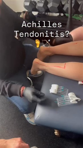 🦶 Dry Needling for Achilles Tendinopathy 🎯 Persistent Achilles pain can be more than just the tendon itself. Increased calf muscle tone, altered load tolerance, and pain sensitivity all play a role. Dry needling can help by ✨ Reducing excessive muscle tone in the calf complex ✨ Modulating pain through neurophysiological mechanisms ✨ Improving movement efficiency around the ankle ✨ Supporting rehab by allowing better loading tolerance It is not a standalone fix. Best results come when dry needl