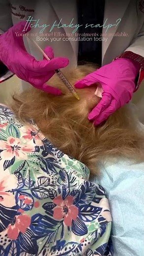 ✨ Understanding Scalp Psoriasis ✨