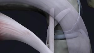 3D Reconstruction of the Posterolateral Corner of the Knee