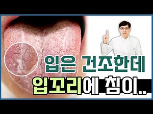 구강건조증과 구각유연증/ 입안은 마르는데 입꼬리에 침이 고여요