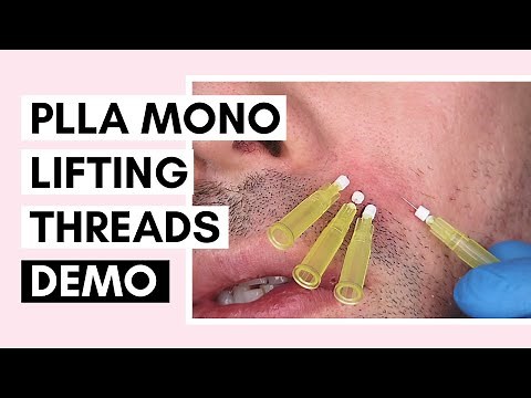 PLLA Mono Thread Lift On Forehead and Nasolabial Folds Ft @Vanidiy