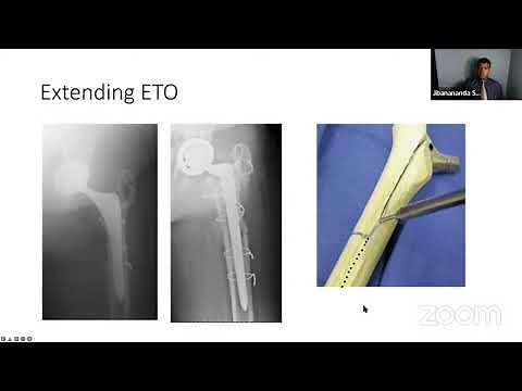 Complex Revision Hip Arthroplasty