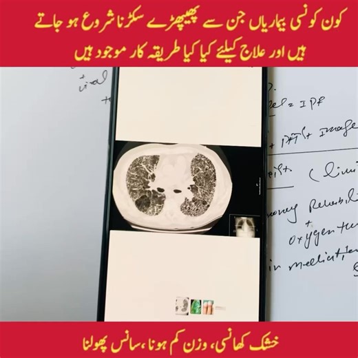 38K views · 473 reactions | Pulmonary fibrosis causes scarring of lung tissue, leading to breathing difficulties. Treatment options include medication, oxygen therapy and lung transplant. | Dr Shahbaz Akhtar | Facebook