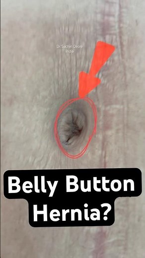 Belly Button Hernia (Umbilical Hernia) – Bulge Appears When Coughs | Laparoscopic Hernia Surgery