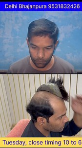 Clip and fixing hair patch 🤗 #hairpatch #hair #service #reels | Parvez Hair