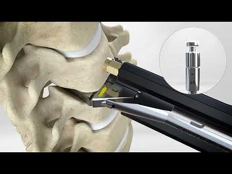 prodisc C Vivo Surgical Technique w/ prodisc Cervical V2 Instrument Set | Cervical Disc Arthroplasty