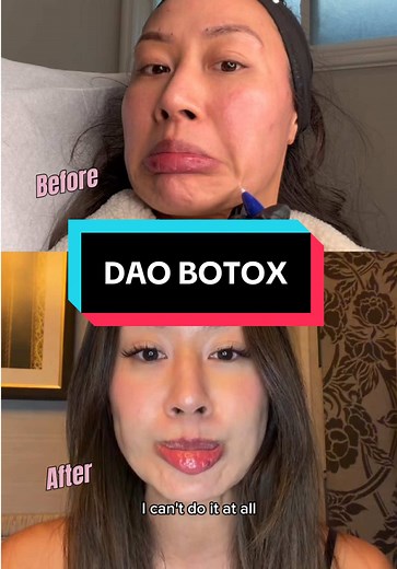 DAO Botox Treatment for Downturned Mouth & RBF