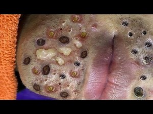 Relax Every Day With Loan Nguyen Spa | Acne Treatment Pimple Popping #5