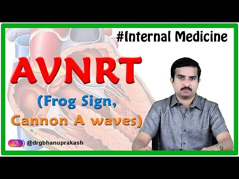 Atrioventricular nodal reentrant tachycardia (AVNRT) / Internal medicine / USMLE Step 2 ck