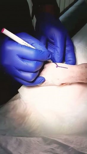 Canine digit amputation planning