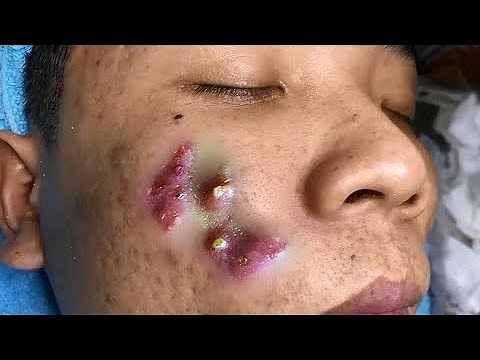 Big Cystic Acne Blackheads Extraction Blackheads & Milia, Whiteheads Removal Pimple Popping