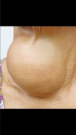 Goiter! Huge Thyroid Growth in Someone’s Neck!