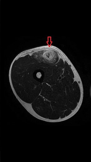 Bulls Eye Sign #radiology #physiotherapy #athletictraining