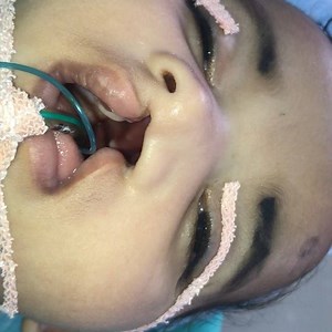 Immediately before and after cleft lip repair by dr sunil richardson #teamworkmakesthedreamwork “We make all kids with clefts just like kids without clefts” #plasticsurgery #cleft #plasticsurgeon #clefts #cleftlip #cleftbaby #cleftlipandpalate #cleftlipcutie #cleftliprepair #cleftawareness #cleftstrong #cleftproud #orthodontics #orthodontist #dentista #dentistas #dentalstudent #medico #medstudent #medicalschool #stanford #muscat #cleftpalate #cleftcutie #facialplasticsurgery #facialplasticsurgeo