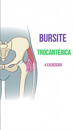 Trochanteric Bursitis Exercises (Trochanteritis) #bursitis