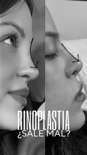 1.1M views · 10K reactions | Review de mi rinoplastia  || se aceptan recomendaciones de otorrinos en Monterrey Graxxx de antemano, hermanas. Love you. . . . #rinoplastia #rinoremodelación #rinimodelación #rinoplasty #nosesurgery #rhinoplasty #rhinoplastyreviews #ojoencapotado #maquillaje | Gabytopia | Facebook