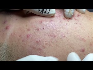 Acne treatment for Spa Linh Mun 2024 #85