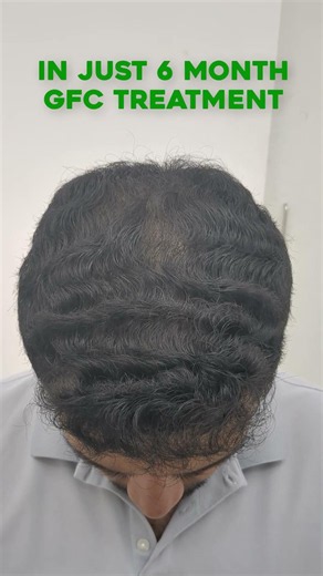 GFC Hair Treatment Success Story 💯 Hair Transformation ✨