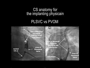 Patent vein of Marshall (PVOM) vs small persistent left superior vena cava PLSVC for implanter