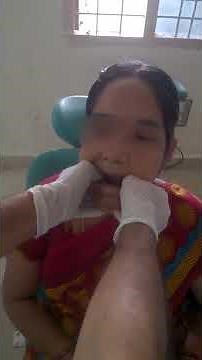 Jaw Joint Dislocation (Slip) - Manual Reduction (Self / at Home Treatment (DIY)