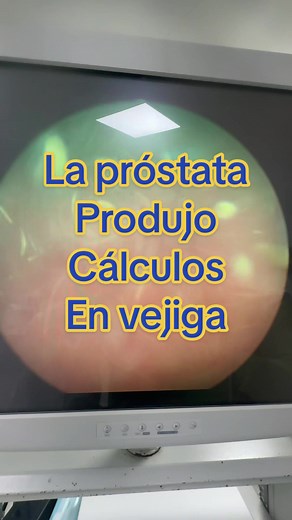 Cálculos en la vejiga por próstata grande: causas y soluciones