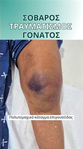 Σοβαρός τραυματισμός γόνατος | Πολυτεμαχικό κάταγμα επιγονατίδας