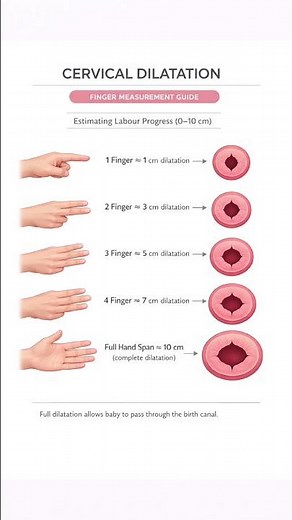How to Measure Cervical Dilatation #nurse #CervicalDilatation #LaborManagement #midwifery