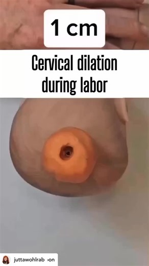 Curious about how the cervix opens during labour? Typically, the cervix is about 3 to 4 cm long during pregnancy and gradually softens and shortens as it gets closer to delivery. To fully prepare for birth, it needs to open about 10 cm- that's quite an incredible process that allows your baby to pass through and be born. Interestingly, the German word for cervix is “muttermund,” which means' mother's mouth. ' When the cervix is fully dilated, it means the next step in labour has been reached. Th