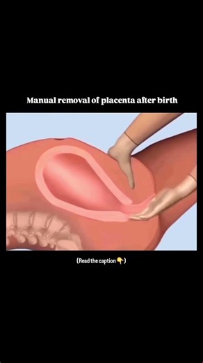 “Manual Removal of Placenta – a life-saving obstetric procedure.”