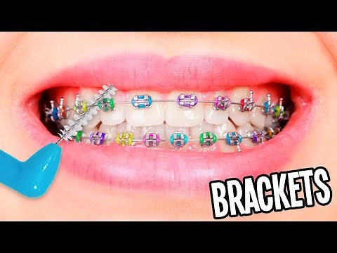 11 TRICKS FOR THOSE WITH BRACES ❤️ - Belen Tutorials
