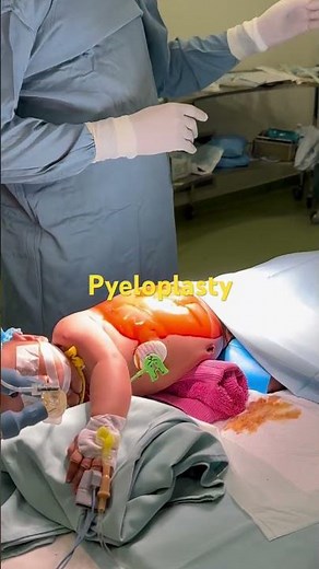 Pyeloplasty fora 2 months old child by Dr Mathula Hettiarachchi.👶👍#children #surgeon