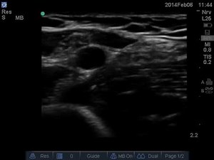 Ultrasound assessment of the brachial artery and vein in the antecubital fossa with BMode ultrasound