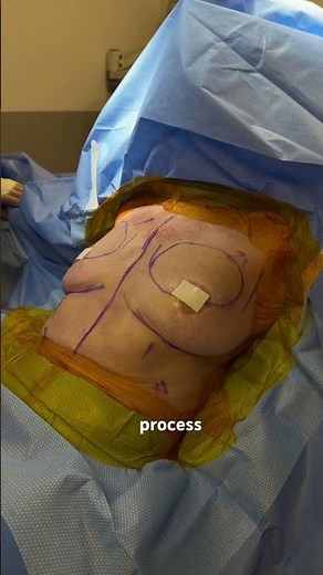 Addition-Subtraction Augmentation Mastopexy: Volume Where Needed Without Increased Size (surgical)