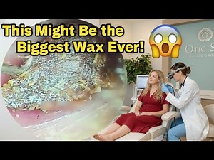“ASMR Earwax Removal — Giant Chunk Edition!”