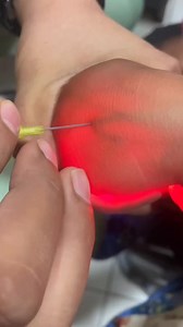 2.3M views · 4.2K reactions | Pediatric cannulation by using vein finder.. Nicely done  #doctor #icunurse #ICU #nursing #nurse #emergency #laboratory #peadiatrics #anaesthesia | Md Refatullah | Facebook