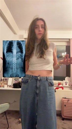 Journey to Spinal Fusion Surgery: My Story