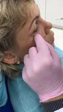 Volume correction with fillers. #fillers