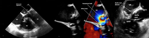Aortic Root Abscess Complicated by Mitral Valve Infective Endocarditis: A Case of Rapid Progression and Fatal Outcome – Archyde