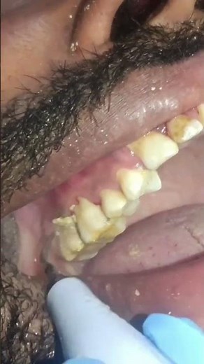 10 years of dental calculus and tartar buildup and removal with ultrasonic🤯 #calculus #Tartar #teeth