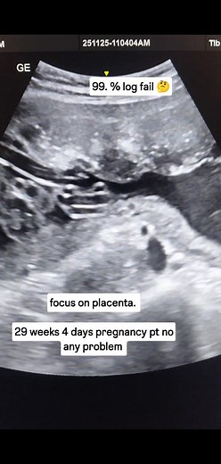 Focus on placenta 29 weeks 4 days pregnancy pt no any problem | Usg Imaging Study
