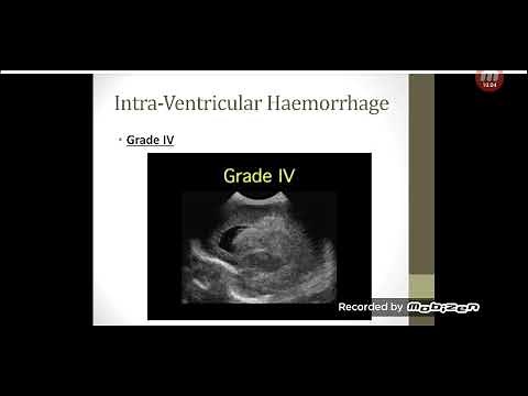 Neonatal Cranial Ultrasound (Part 2)