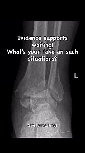 Timing of Fixation Malleolar vs Pilon Fractures