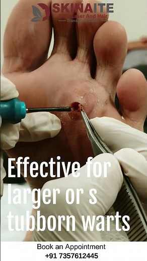 Plantar Wart Removal Treatment – Safe, Fast, Effective & Painless Wart Removal | Skinaite Clinic