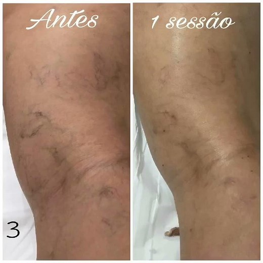 PEIM (procedimento estético injetável em Microvasos)