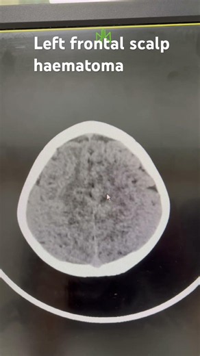 #hematoma #ctscanner #brain #radiology #anatomy #viralvideo #science